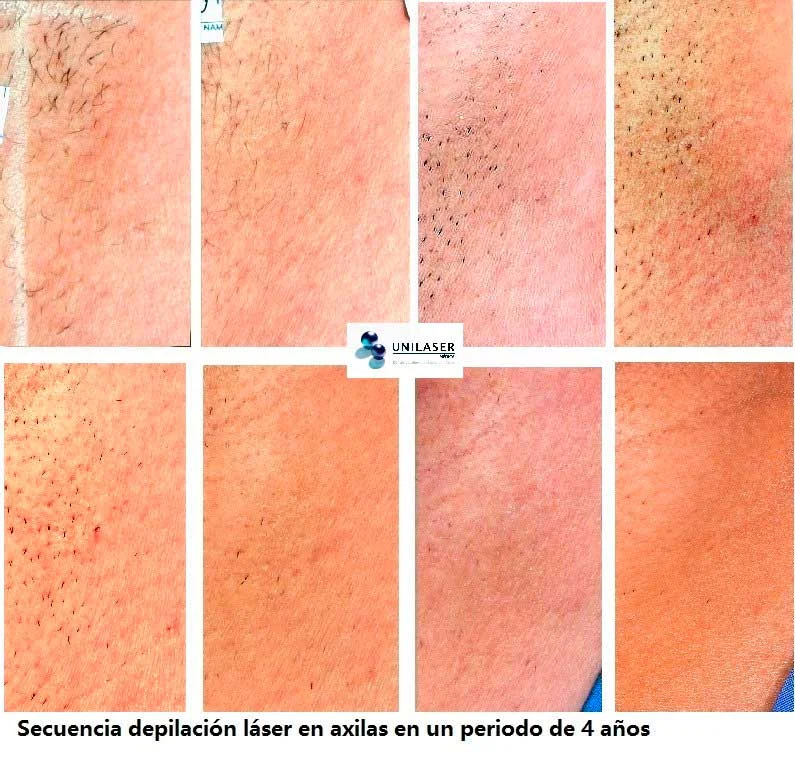 Axilas · secuencia de depilación láser durante 4 años.