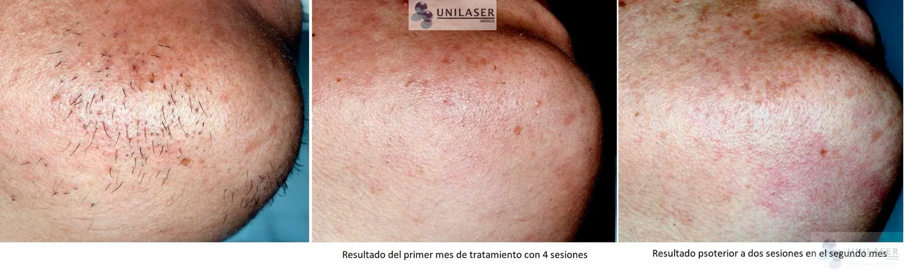 Barbilla · primer mes: 4 sesiones. Segundo mes: 2 sesiones adicionales.