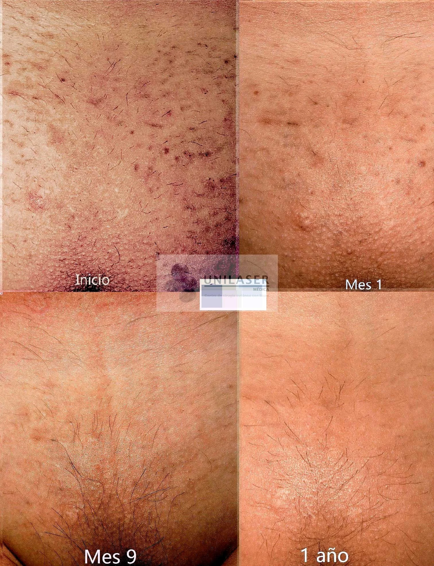 Bikini · inicio, mes 1, mes 9 y 1 año.