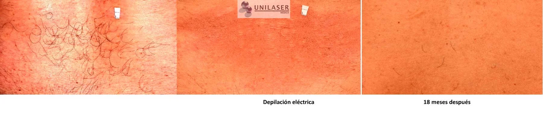 Depilación eléctrica de pelos aislados en región lumbar · control a 18 meses.