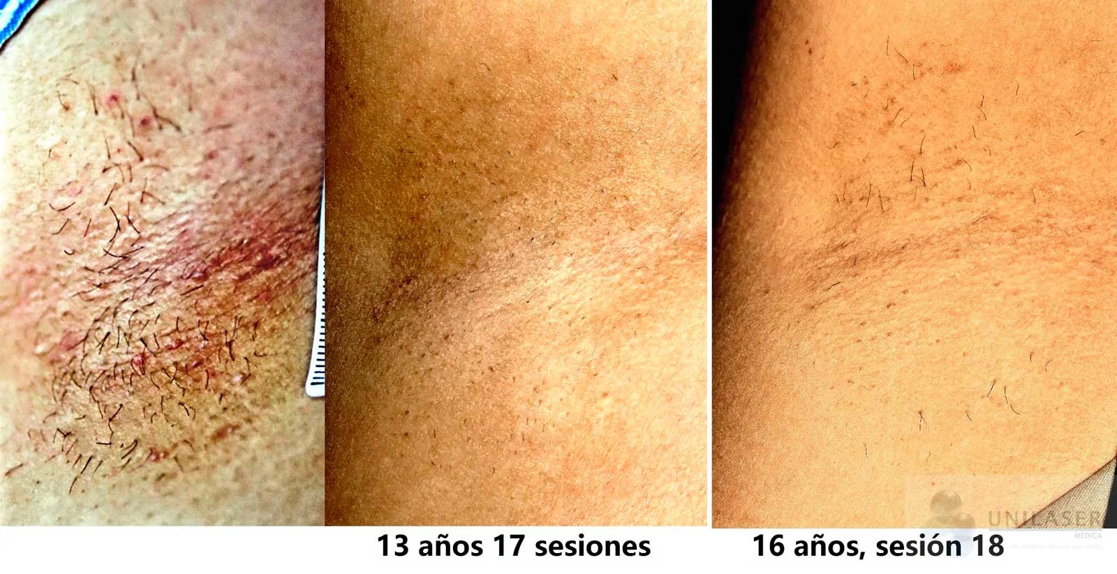 Axila · seguimiento a muy largo plazo: 17 sesiones a los 13 años y sesión 18 a los 16 años.
