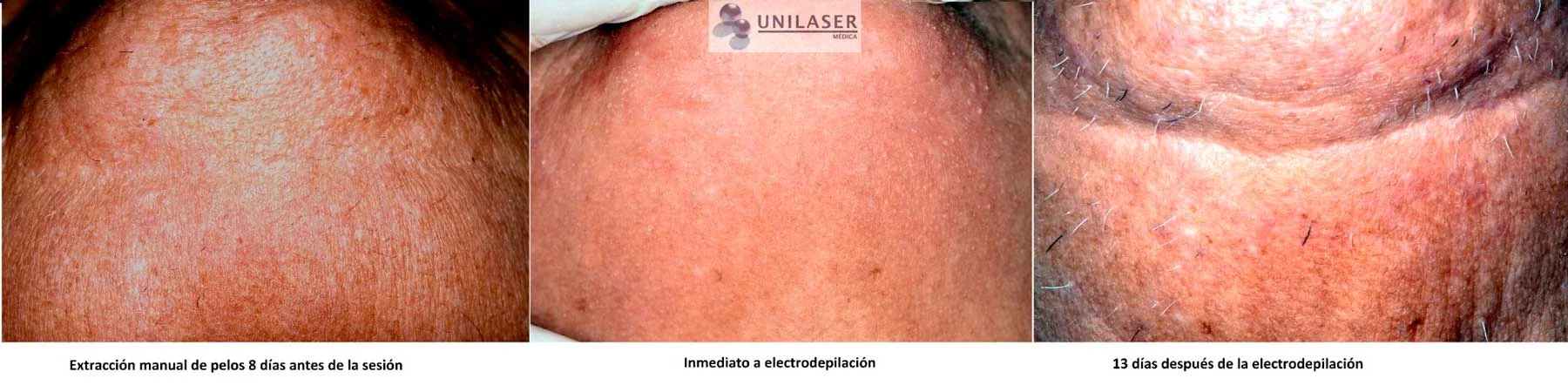 Ejemplo corporal de tratamiento selectivo pelo por pelo.
