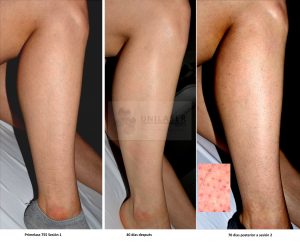 resultado dos sesiones depilación de piernas pelo rubio con Primelase 755