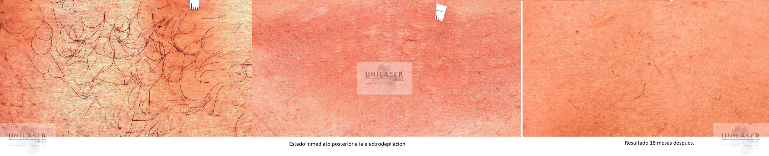 Resultados depilación eléctrica lumbar