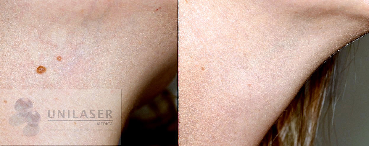 Eliminación de lunares del cuello con láser