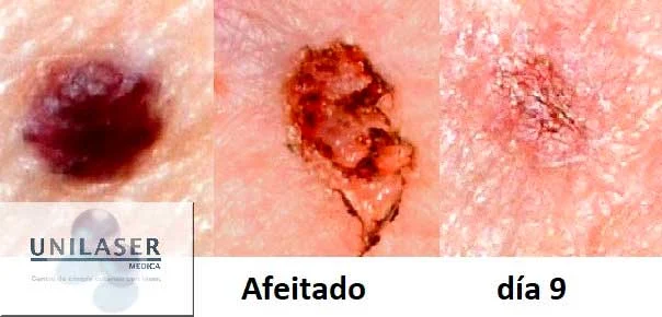 Evolución después del afeitado: aspecto inicial, procedimiento y control al día 9.