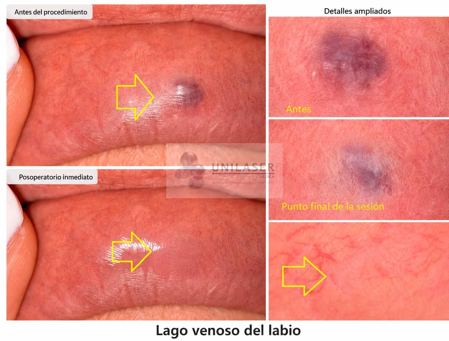 Lago venoso del labio: aspecto inicial, punto final de la sesión y detalle del área tratada. Las flechas señalan la localización de la lesión.