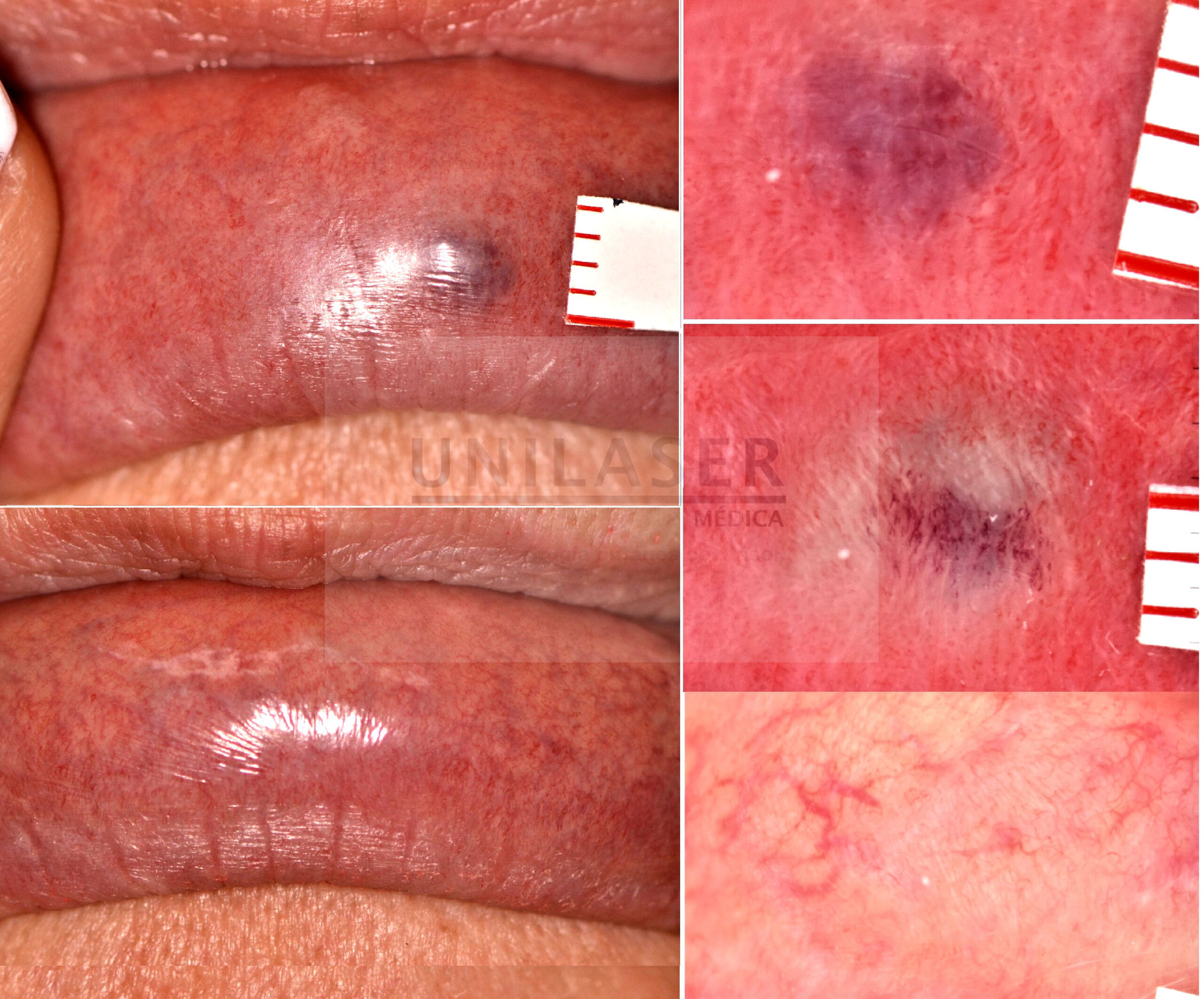 venous lake of the lip treated with laser