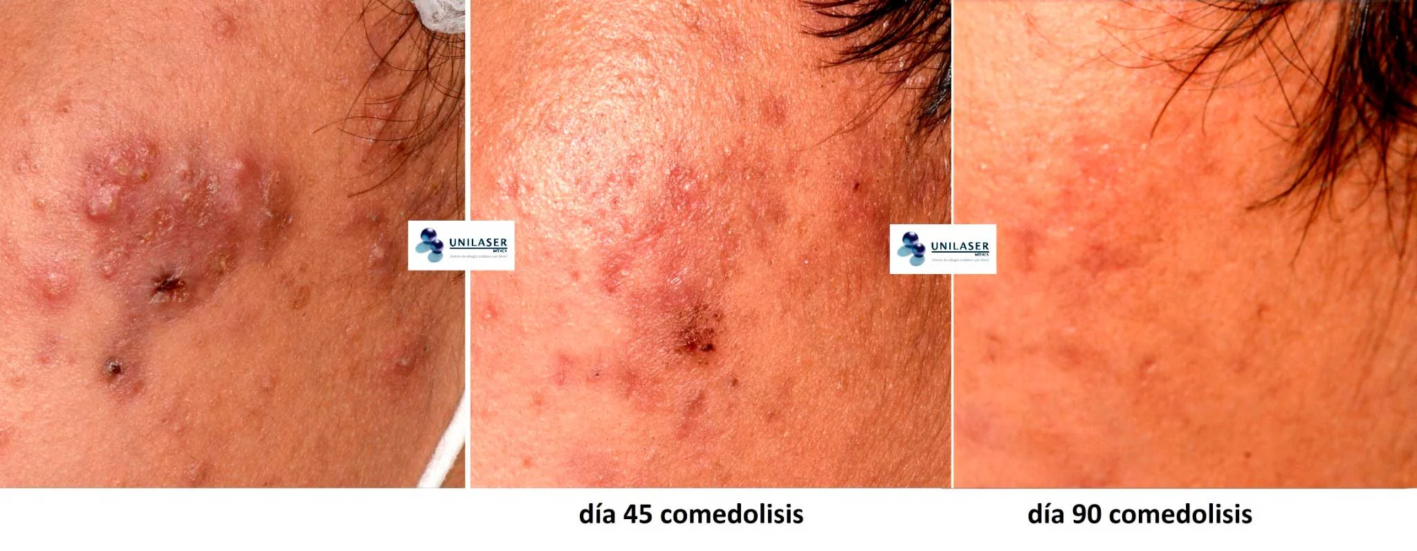 Lesiones confluentes. Evolución a 45 y 90 días después de la comedólisis, con disminución progresiva de la inflamación y de las lesiones visibles.