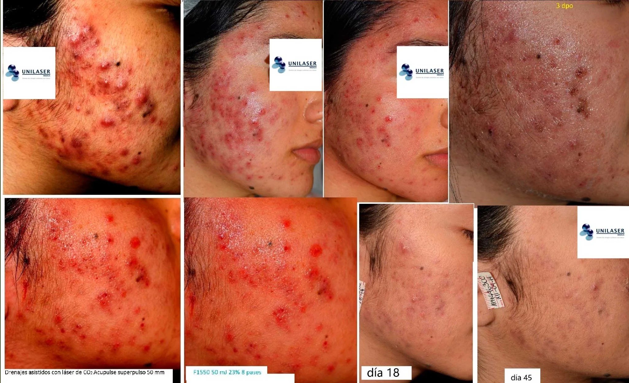 Lesiones inflamatorias profundas y confluentes. El tratamiento se dirige primero a desobstruir y drenar las lesiones activas y, durante la evolución, a acompañar la cicatrización temprana de la piel.