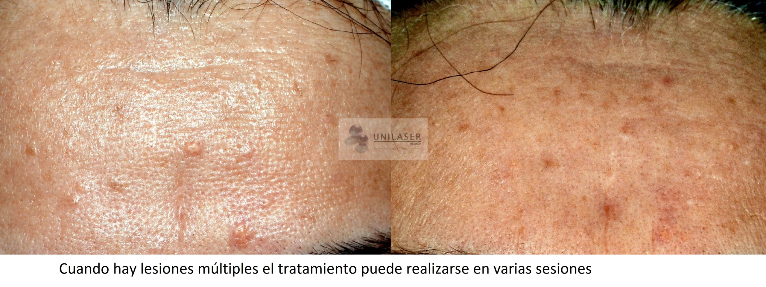 Lesiones múltiples