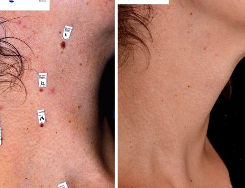 Laser for the moles of the neck