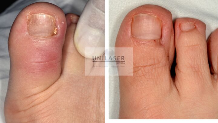 Ungrown toenail