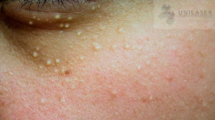 Milia múltiples en región periocular.