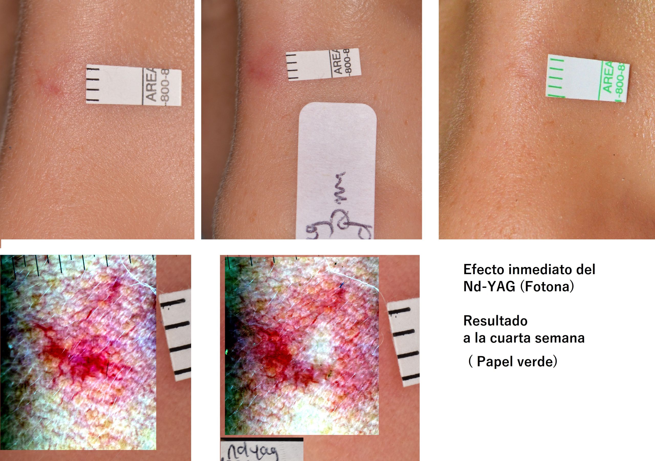 nd yag – copia Spider Nevus tratado con Nd YAG