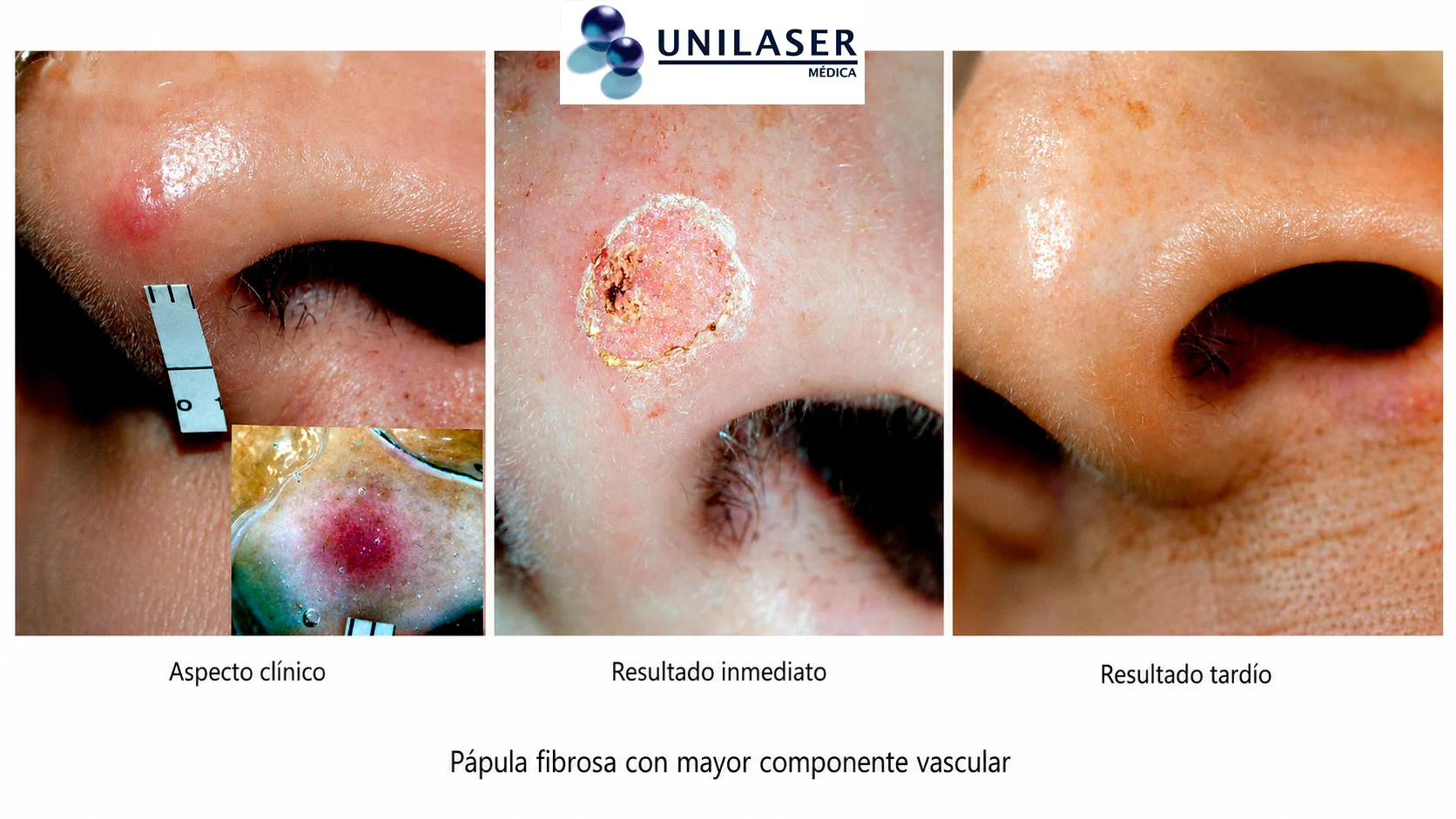 Pápula fibrosa con mayor componente vascular: aspecto clínico, resultado inmediato y resultado tardío.