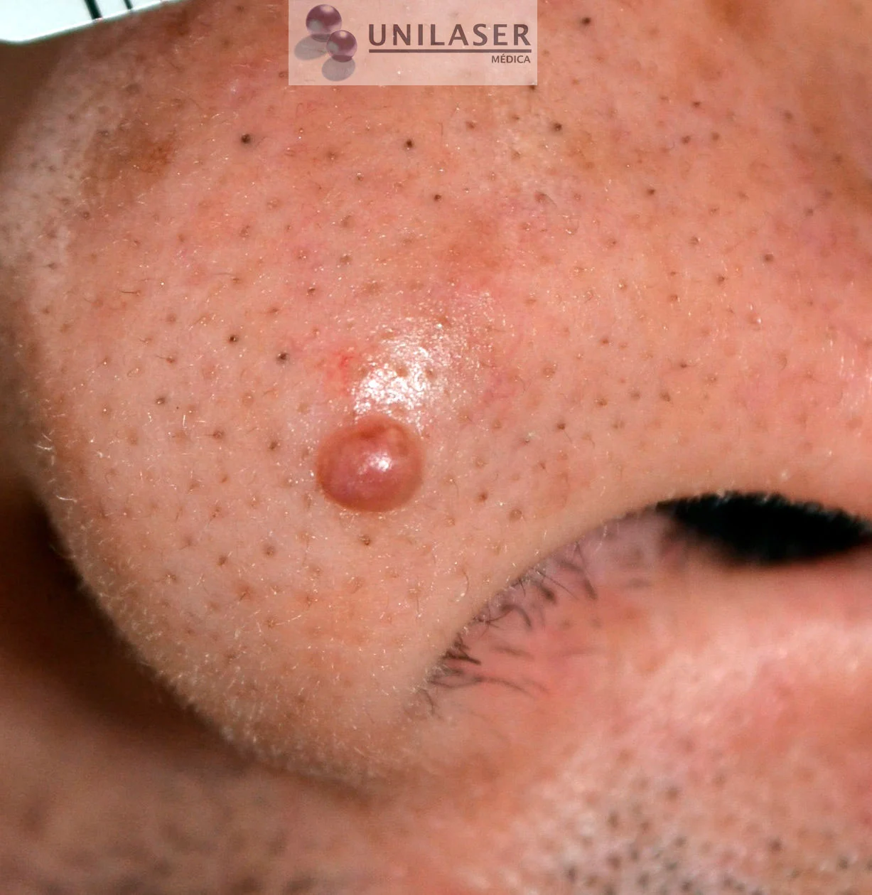 Ejemplo de pápula fibrosa nasal.