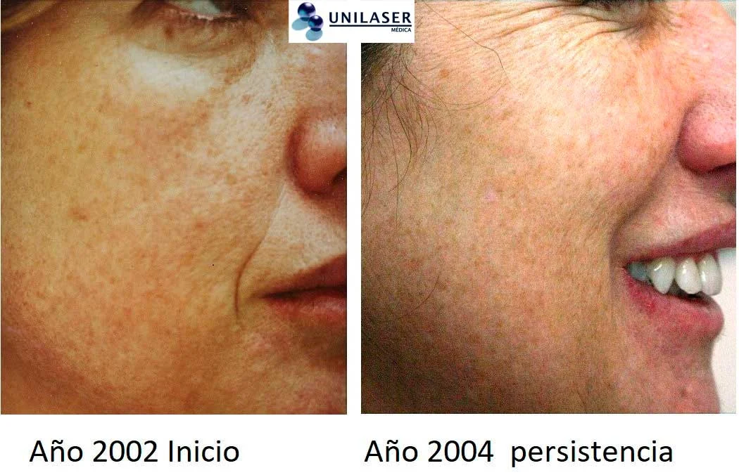 3b. 2002–2004: persistencia de léntigos claros.