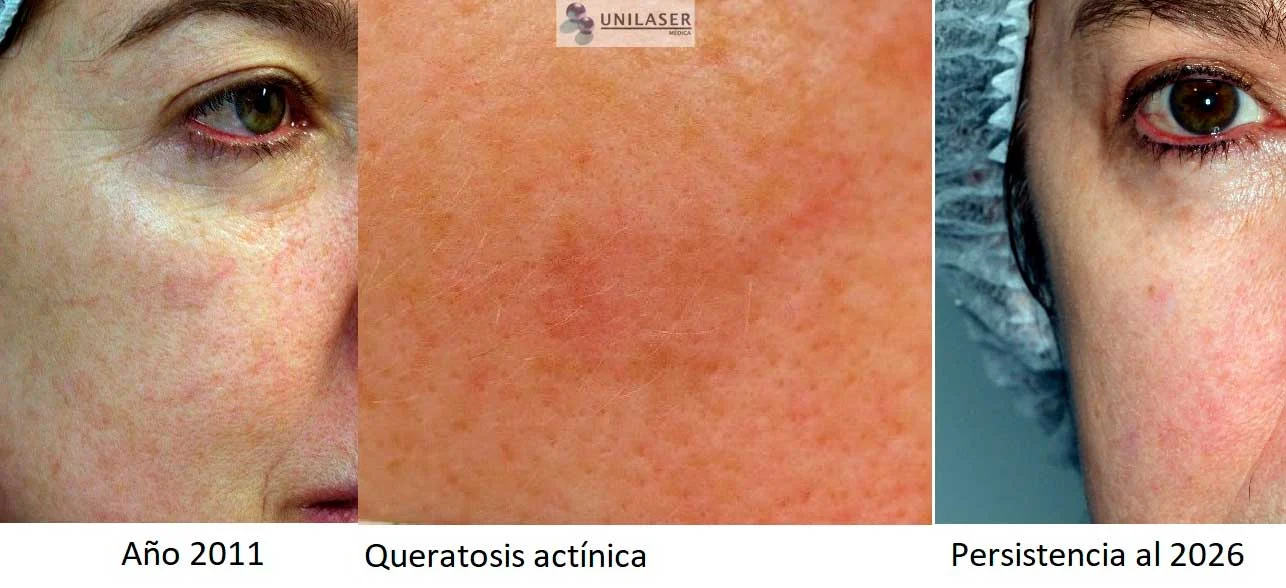 Placa actínica malar derecha durante el seguimiento.