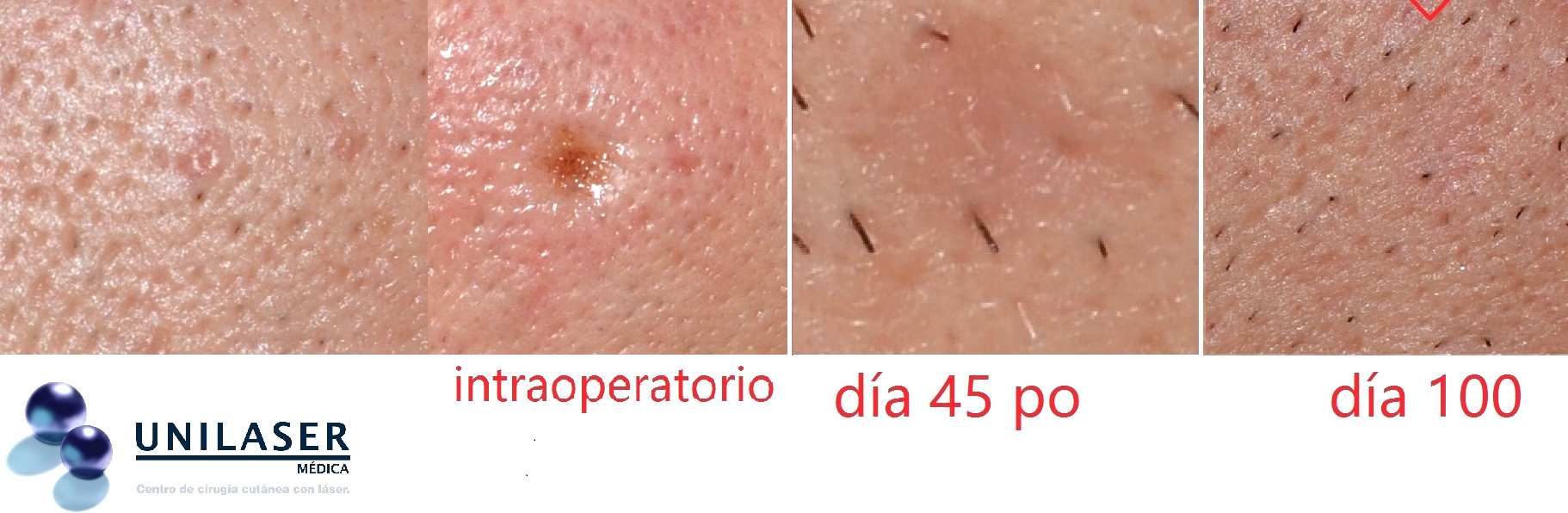 proceso de extirpación de hiperplasia sebácea Técnica de expresión de hiperplasia sebácea