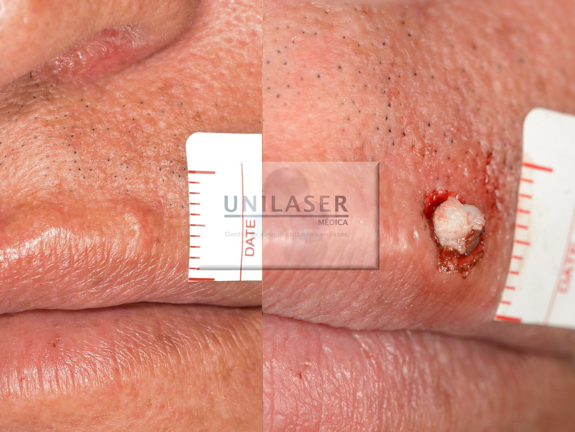 quiste epidermoide del labio Resección quiste epidermoide del labio con láser