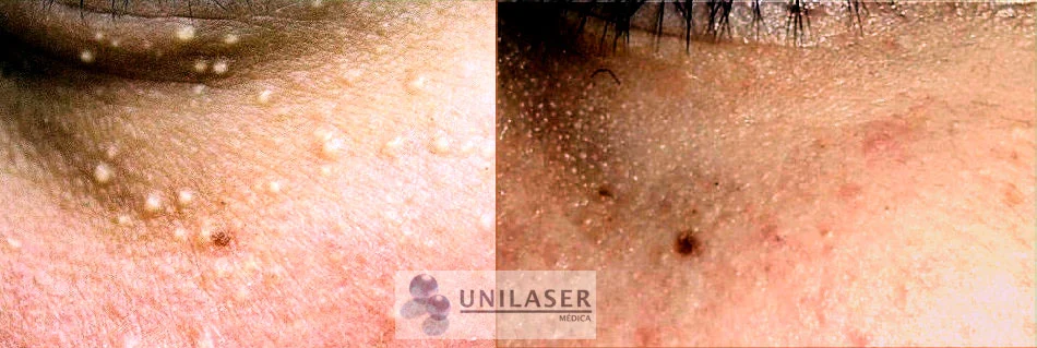 Milia periocular antes y después del tratamiento.