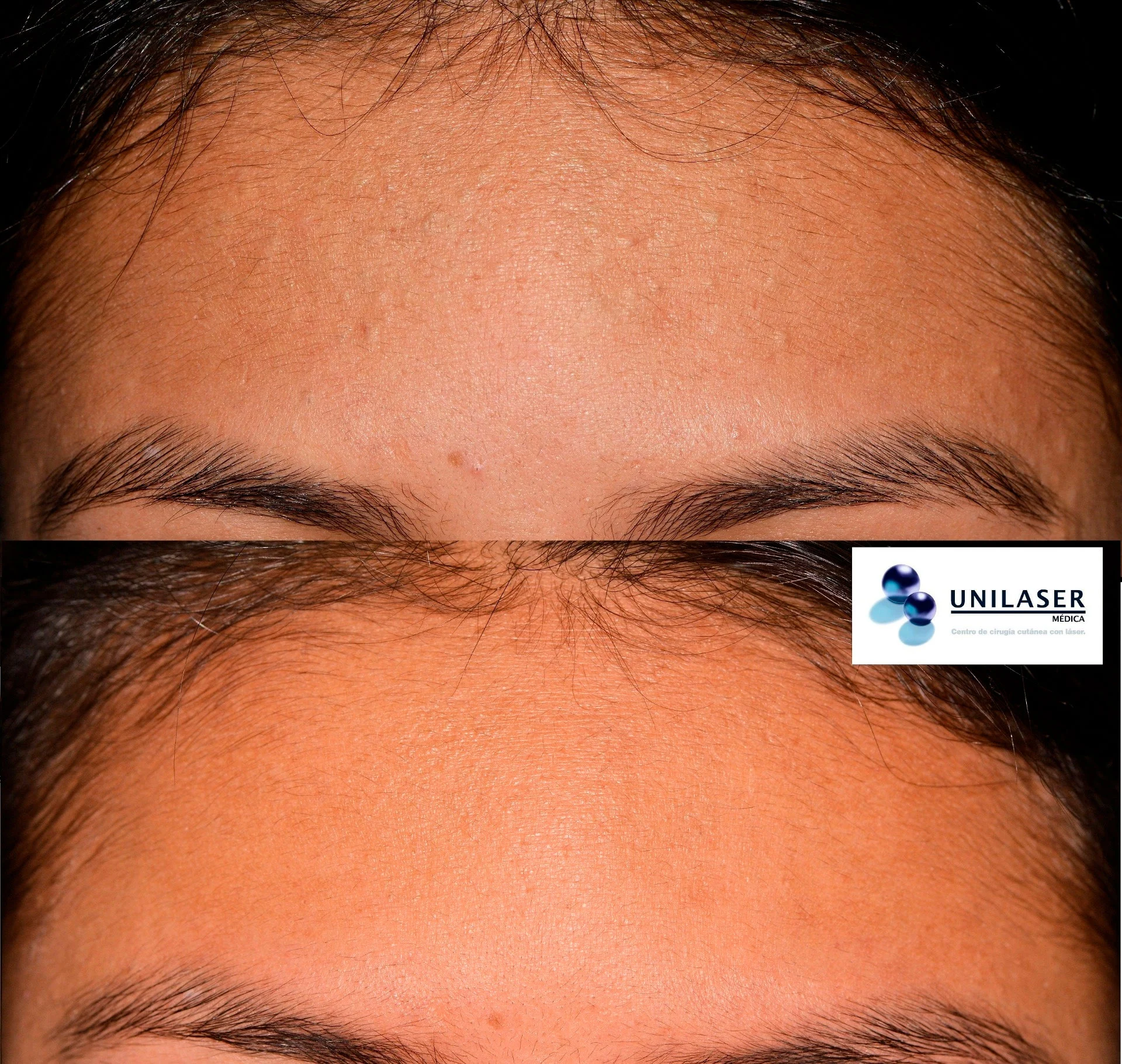 Quistes epidermoides en la frente: fotografía inicial y resultado posterior.