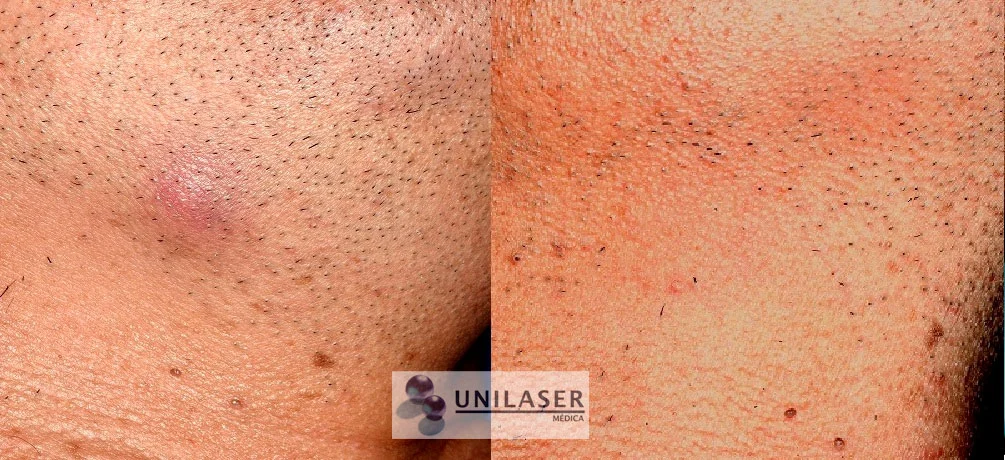 Quiste epidermoide inflamado antes y después del tratamiento.