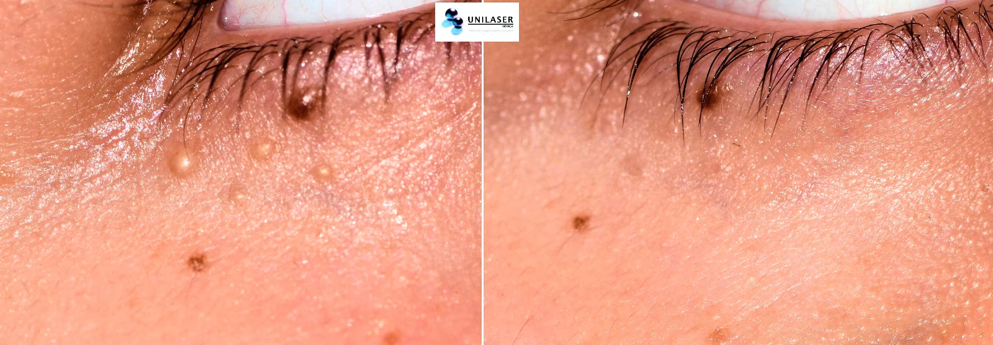 Milia palpebral antes y después del tratamiento.