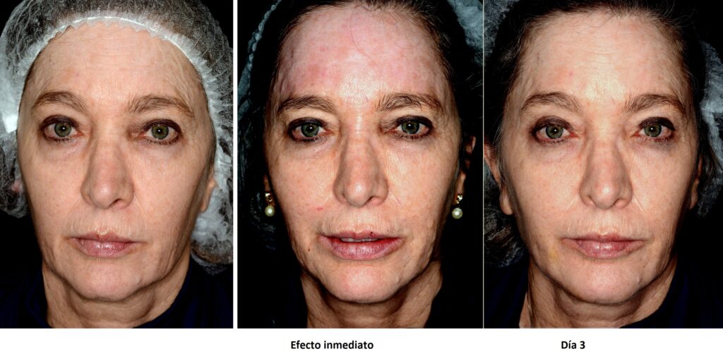Rejuvenecimiento facial con rellenos de ácido hialurónico