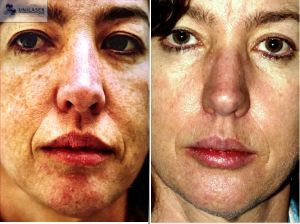 Comparativa frontal del rostro antes y después de un tratamiento láser para fotodaño, con tono de piel más uniforme y menor visibilidad de manchas.