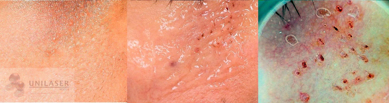 Tratamiento puntual de siringomas. La magnificación permite observar los pequeños defectos que quedan después de tratar cada lesión.