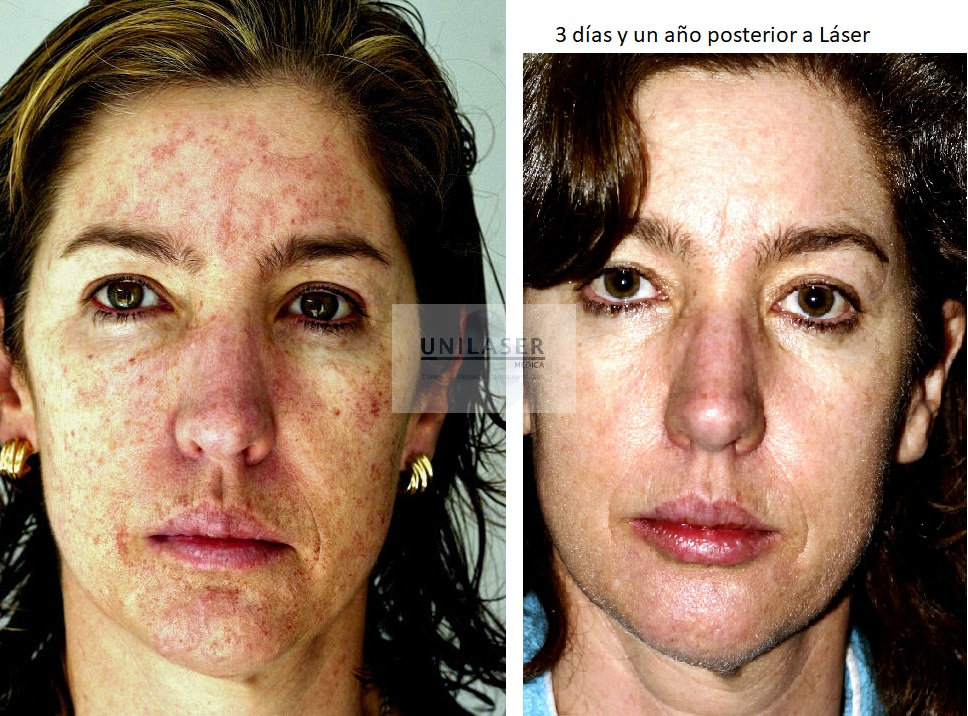 CO2 laser manual fractional technique