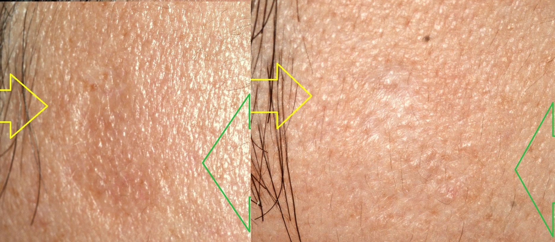 tratamiento cicatriz antigua facial acercamiento tratamiento de cicatrices de la cara