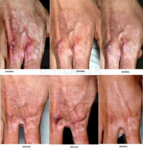 Mes 8 de tratamiento cicatriz por quemadura del dorso de la mano