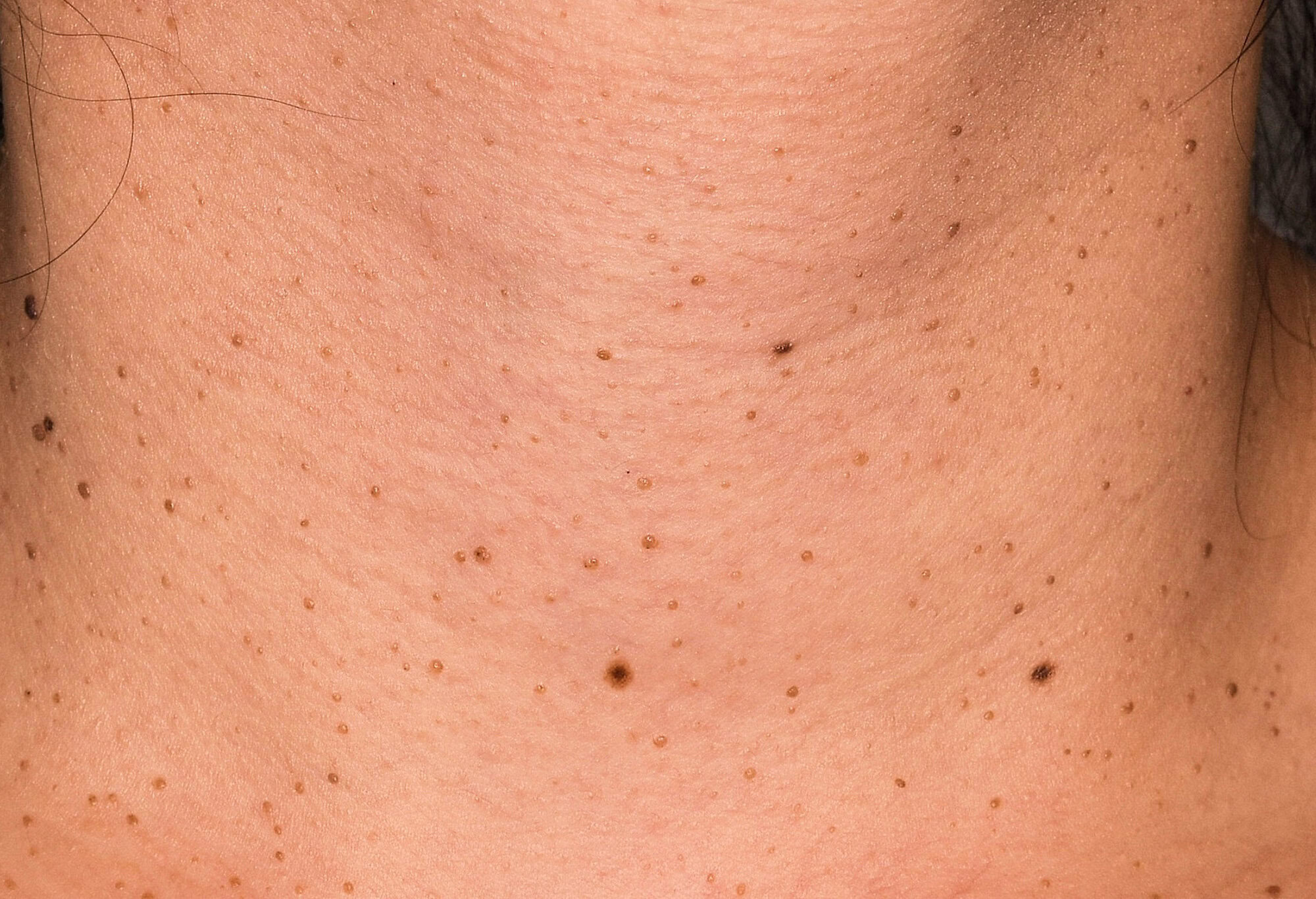 Eliminación de queratosis seborreicas con láser