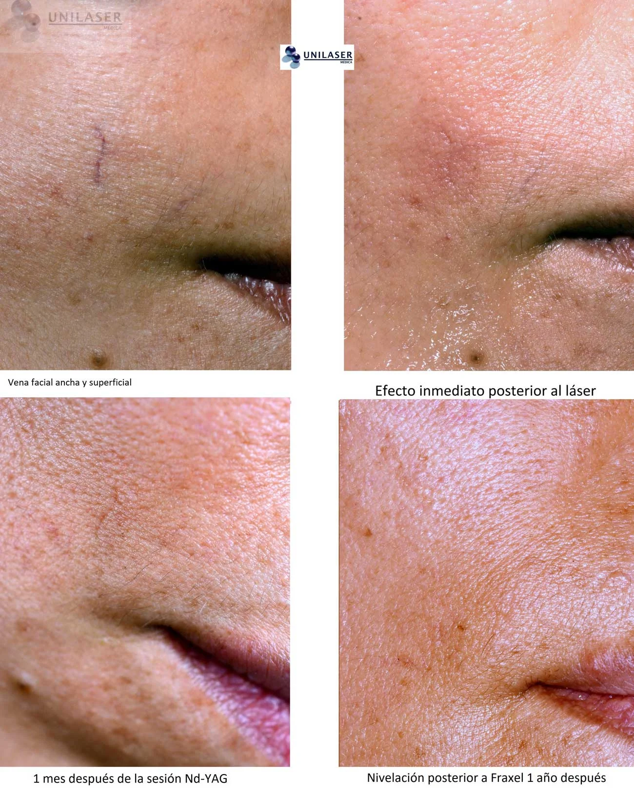 Vena facial ancha y superficial: efecto inmediato y resultado un mes después.