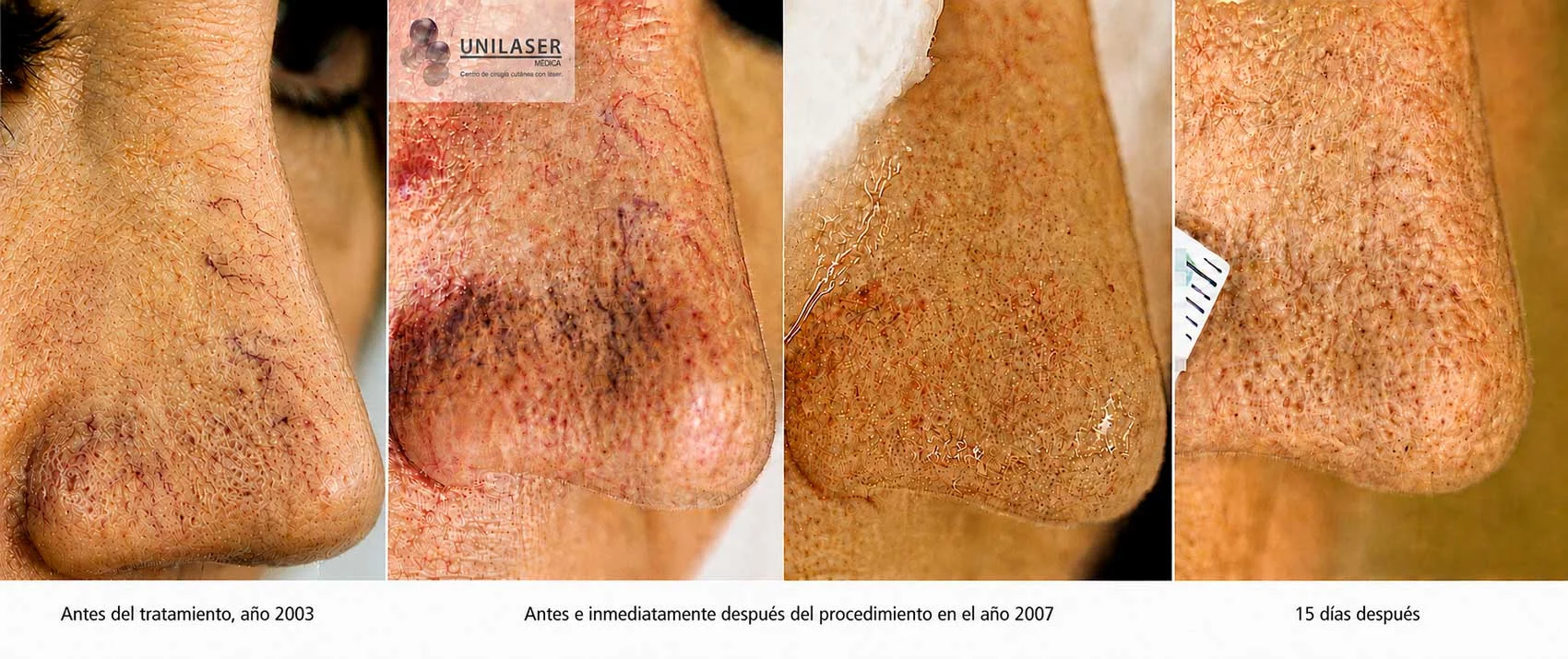 Venas del dorso nasal: estado inicial en 2003; antes y punto final del procedimiento en 2007; control 15 días después.