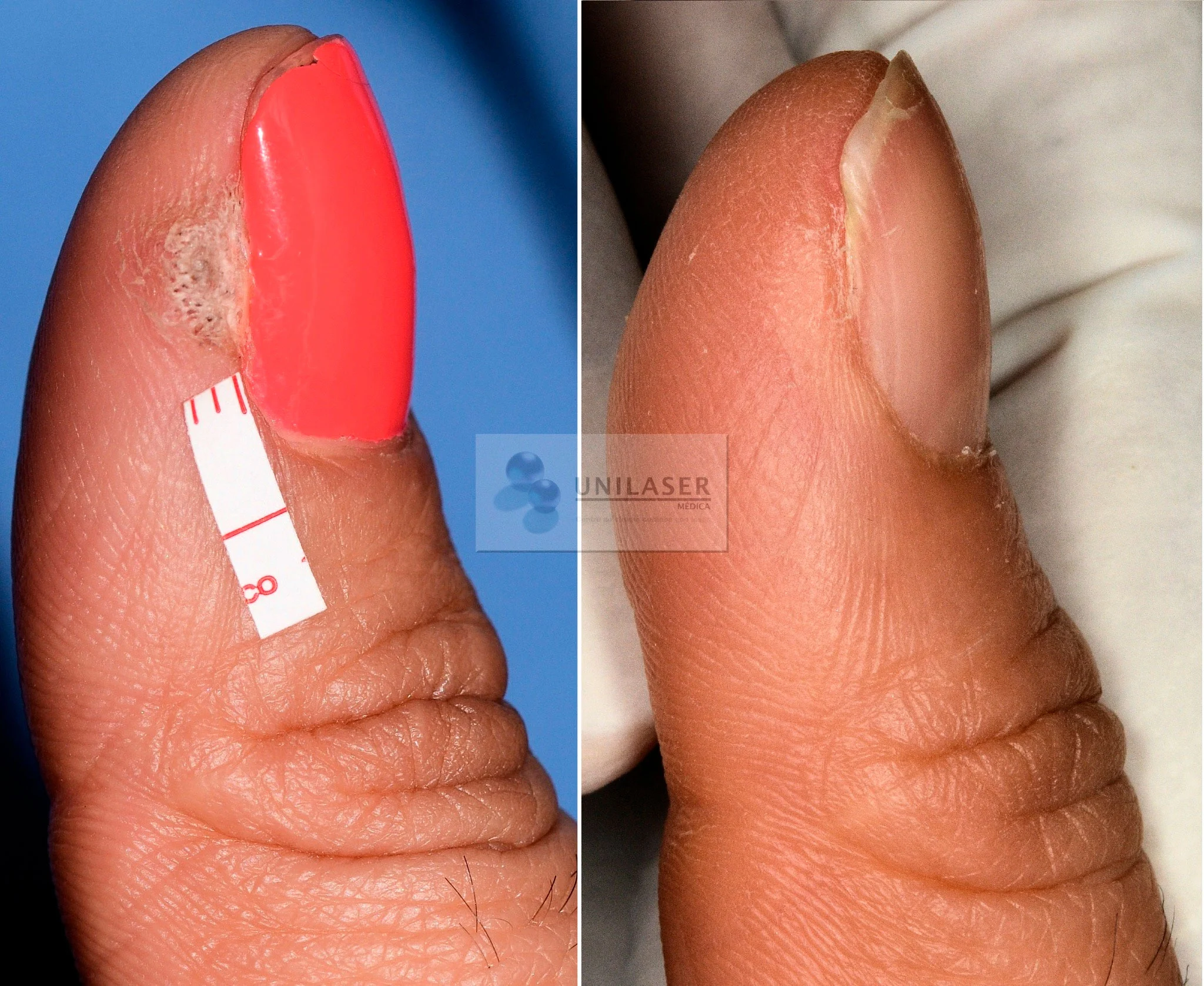 Verruga periungueal del pulgar antes y después del tratamiento.