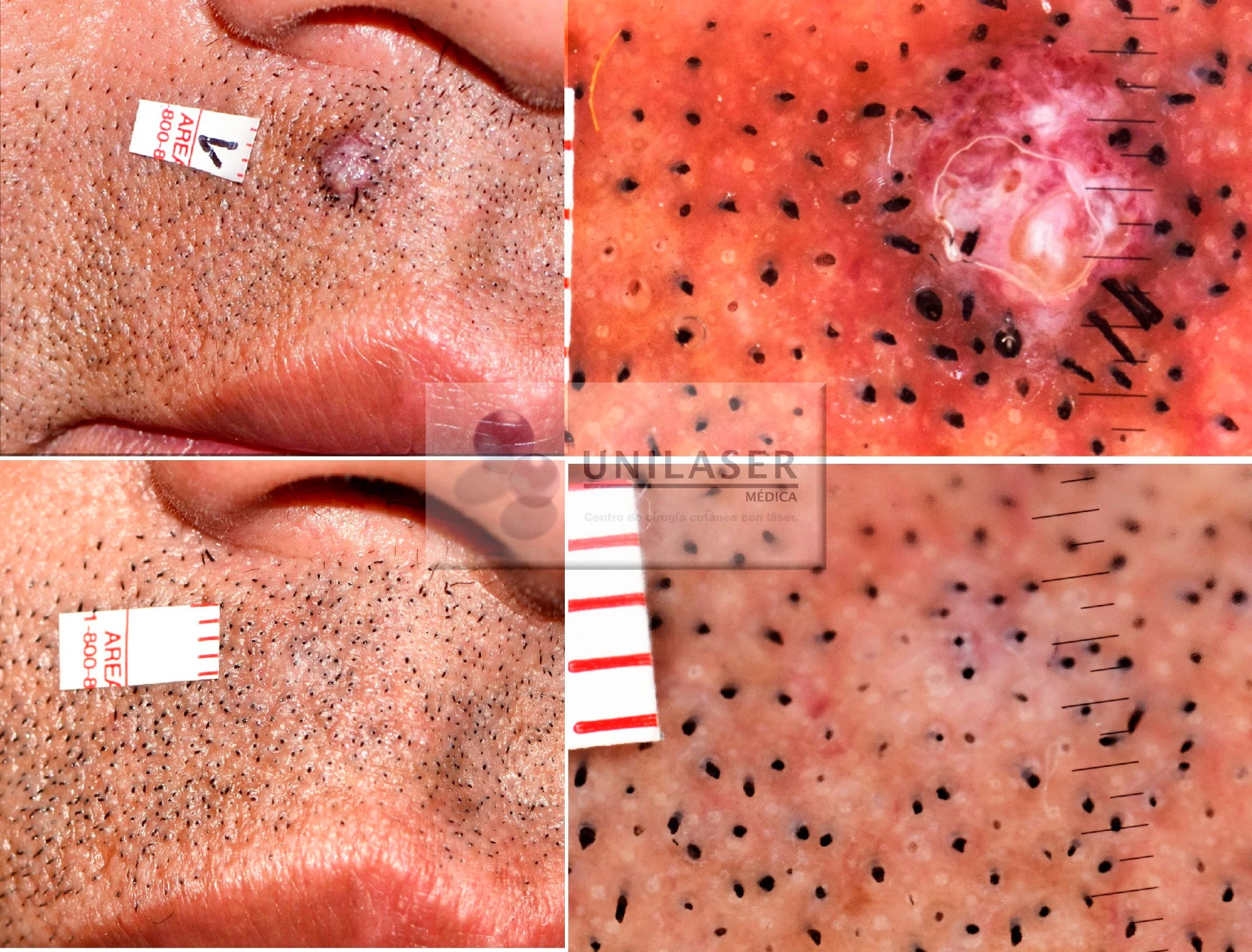 Verruga del labio superior: aspecto inicial, visión aumentada y resultado posterior.