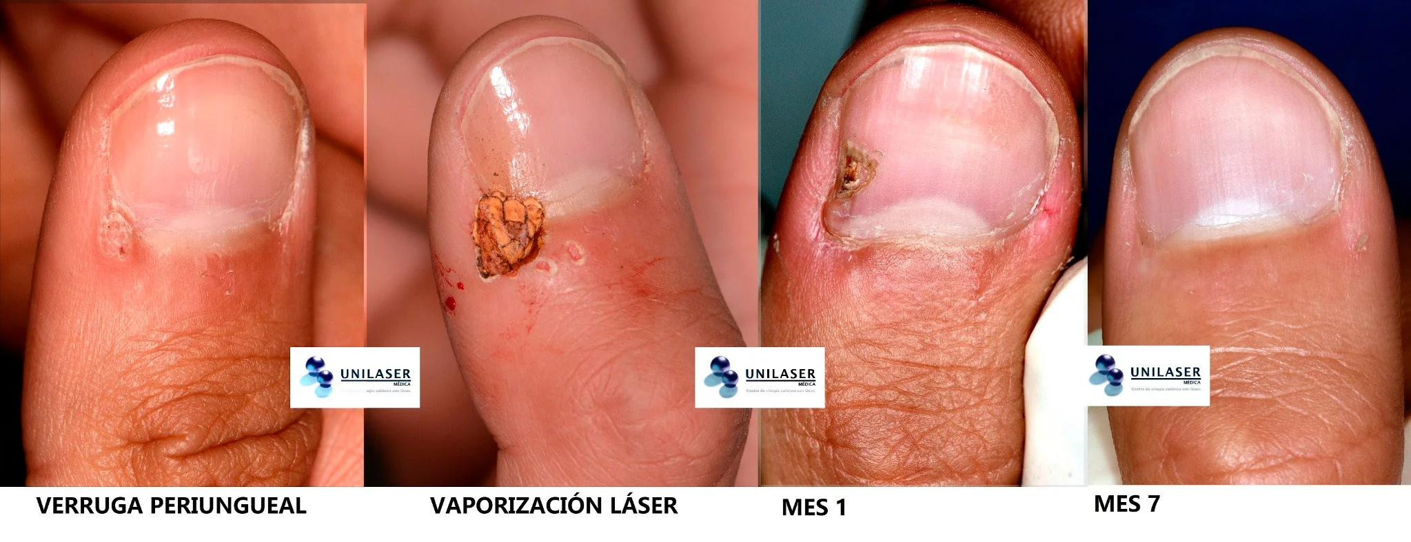 Verruga periungueal: tratamiento, cambio temporal de la lámina y recuperación a los 7 meses.