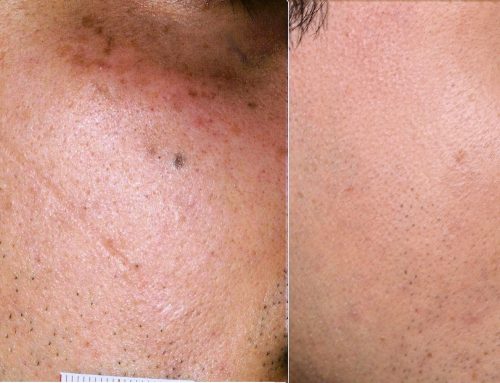 Scars treated with dermabrasion